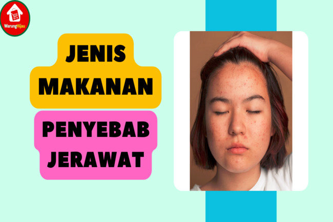 6 Jenis Makanan Penyebab Jerawat yang Dapat Merusak Kulit